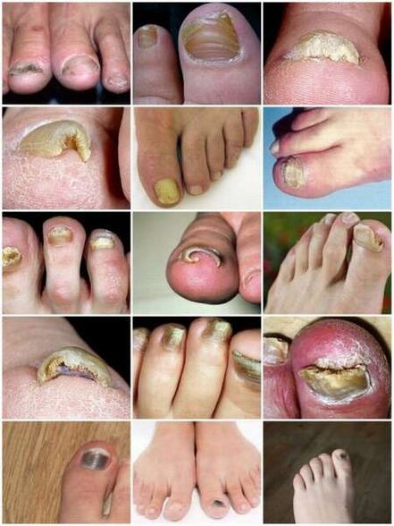 Μυκητιασική λοίμωξη της πλάκας των νυχιών