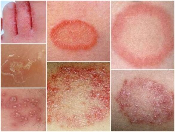 Τριχοφυτίαση του δέρματος των ποδιών